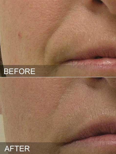 Before & After hydrafacial nasolabial folds nyc